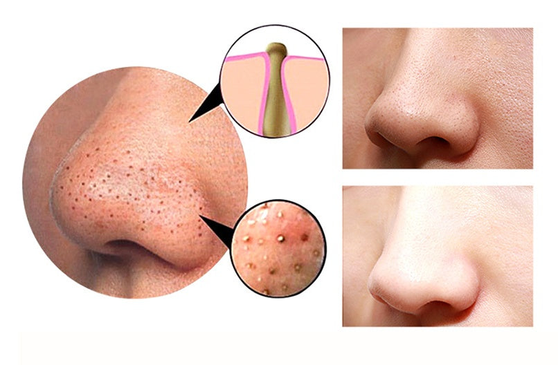 4 in 1 Body Guasha Cupping Blackhead Remover Machine Facial Pore Deep Cleansing Beauty Skin Care - Ectron Online