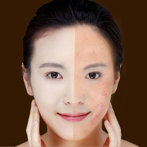 Blue Light Therapy Acne Laser Pen Soft Scar Wrinkle Removal Treatment Device Skin Care Beauty Equipment - Ectron Online
