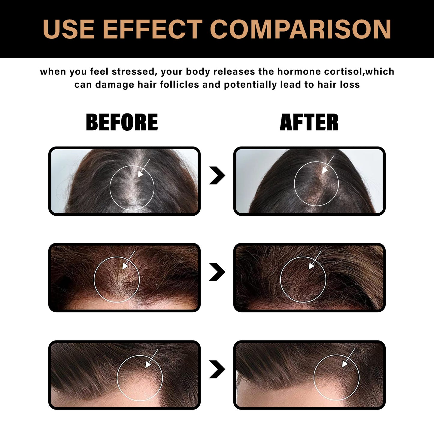 Before and after comparison of hair health with text explaining cortisol's effect on hair follicles.